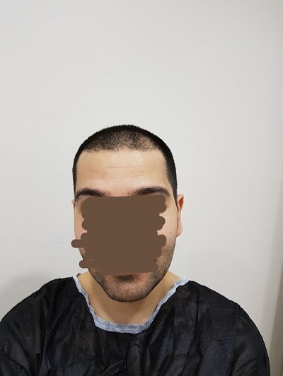 زراعة الشعر بدون حلاقة قبل العملية (3).jpg