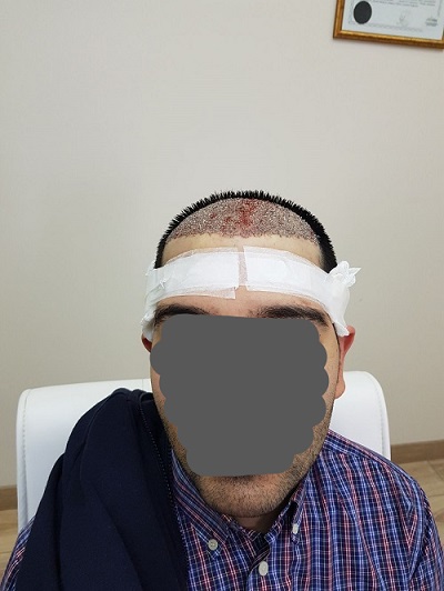 زراعة الشعر بدون حلاقة بعد العملية (3).jpg