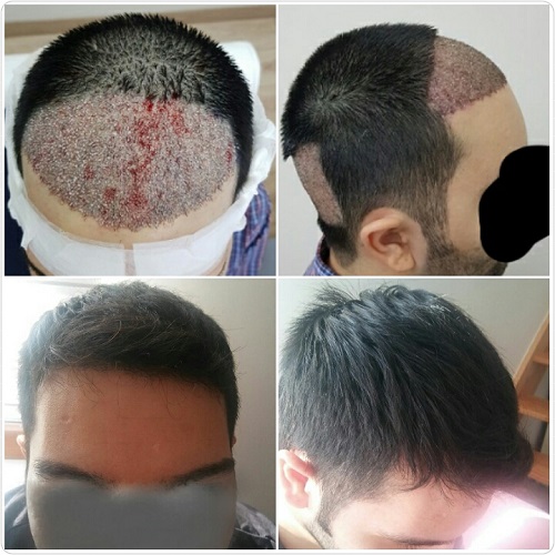 تجارب زراعة الشعر للنساء في تركيا