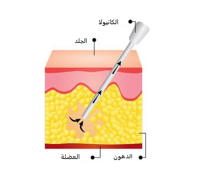 شفط الدهون.png