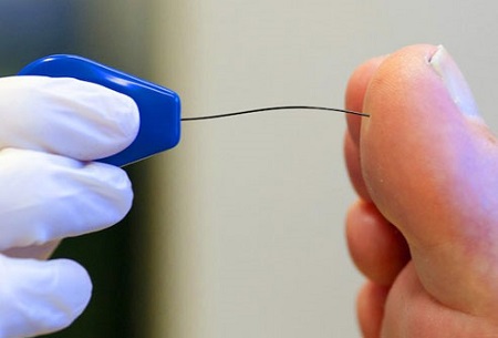 الاعتلال العصبي.jpg