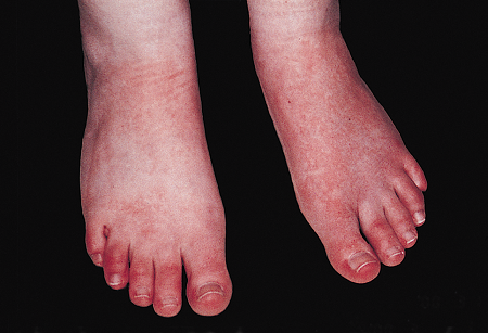 احمرار الأطراف المؤلم.png