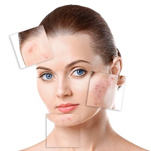 التخلص من اثار الندوب.jpeg