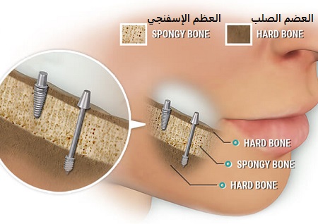 الفرق بين زراعة الأسنان الفورية و التقليدية.jpg