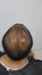قبل العملية زراعة الشعر في تركيا للرجال 5 .jpg